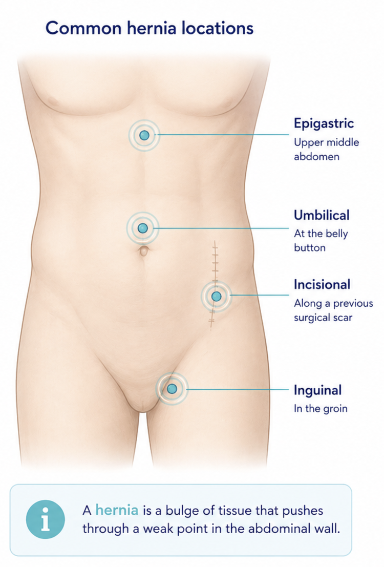 Illustration of common abdominal-wall hernia locations.